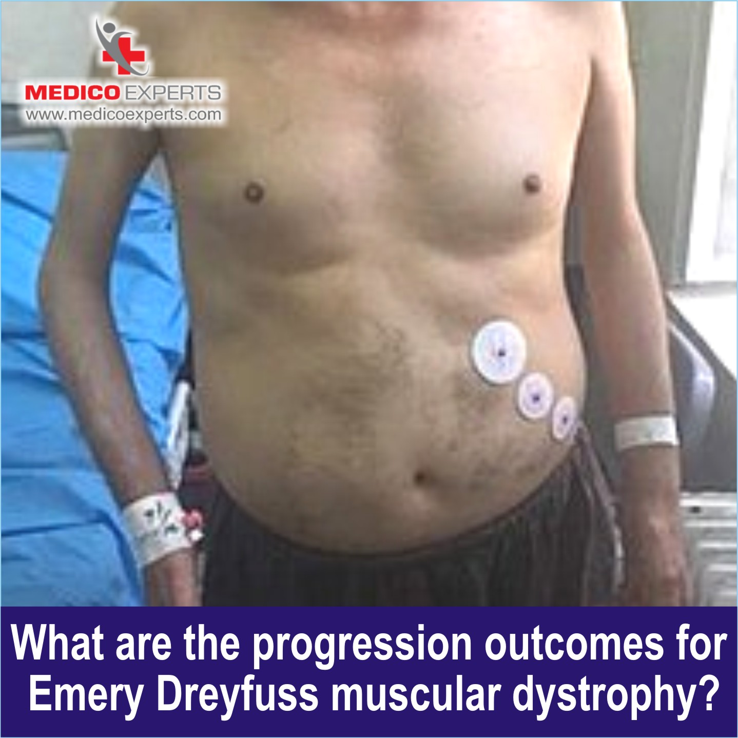 Emery Dreifuss Muscular Dystrophy progression outcomes