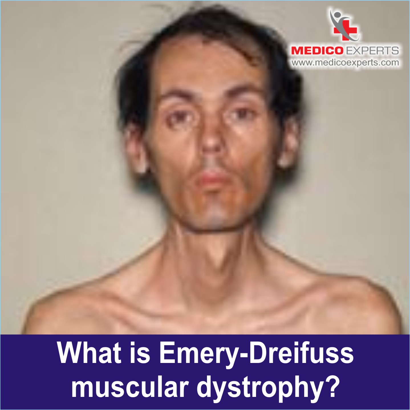 Emery Dreifuss Muscular Dystrophy