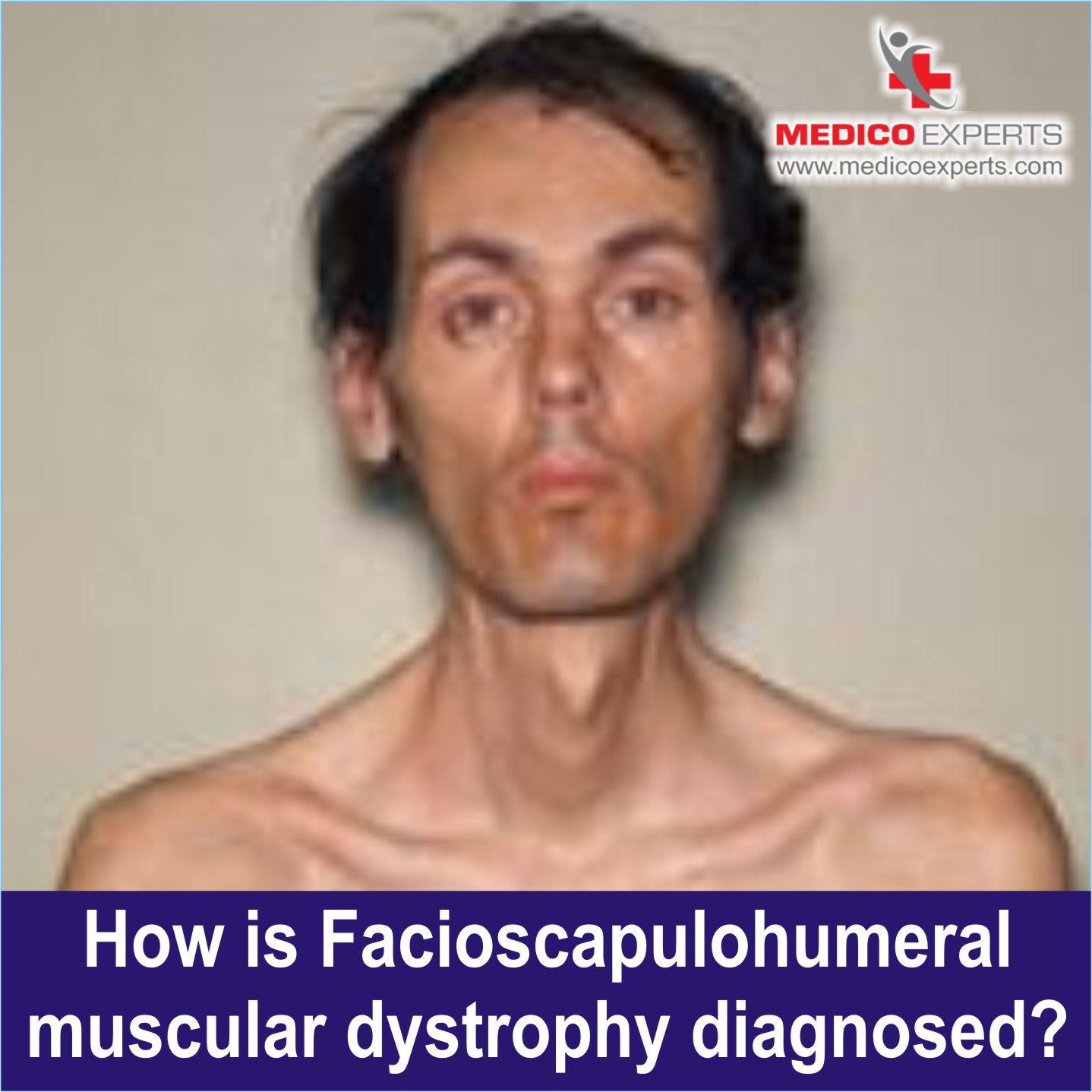 Diagnosis of Facioscapulohumeral Muscular Dystrophy