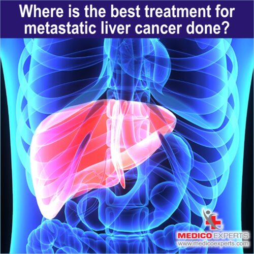 Metastatic Liver Cancer Treatment tumor board approach