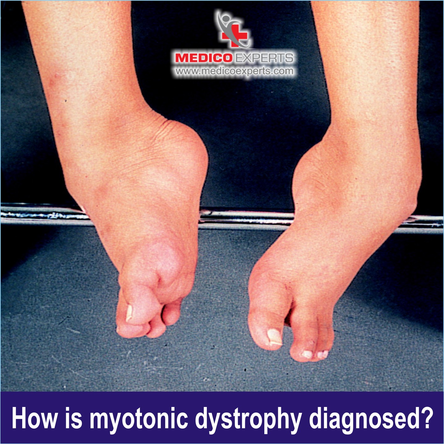 Myotonic Dystrophy Diagnosed