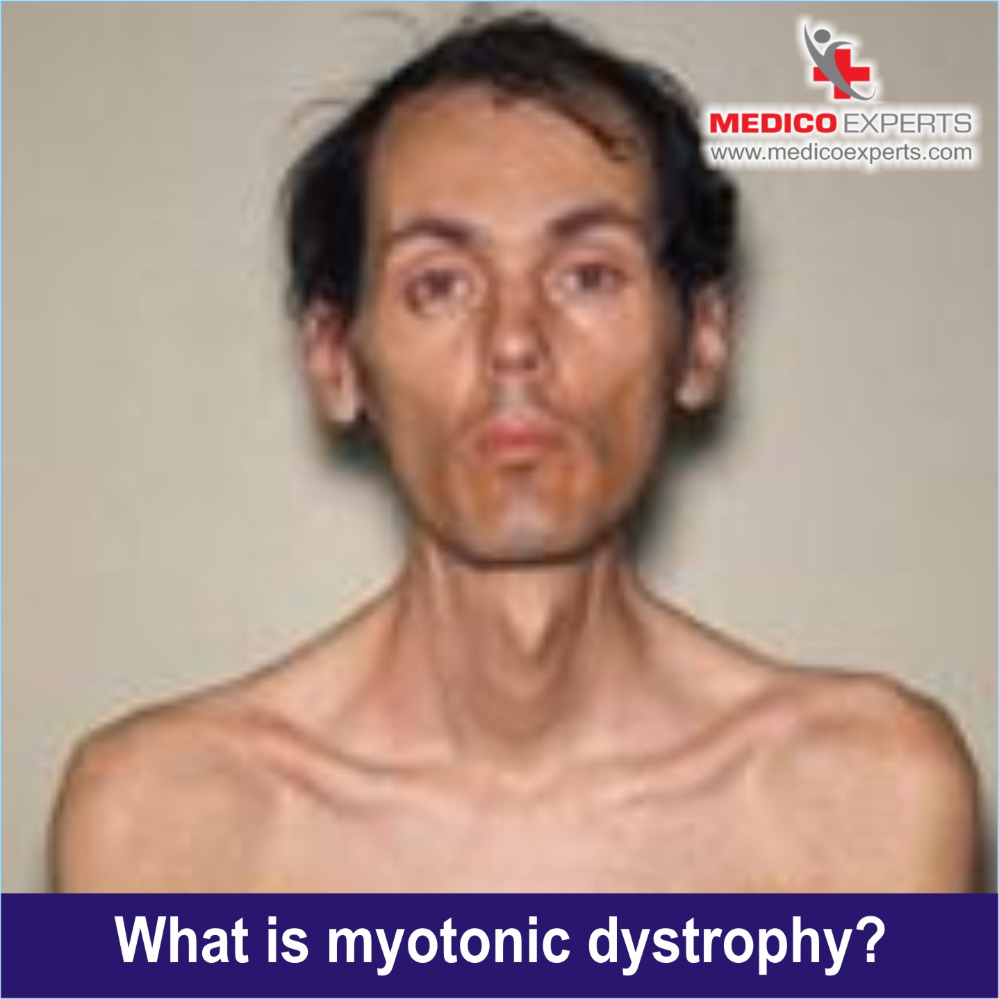 What is Myotonic Dystrophy