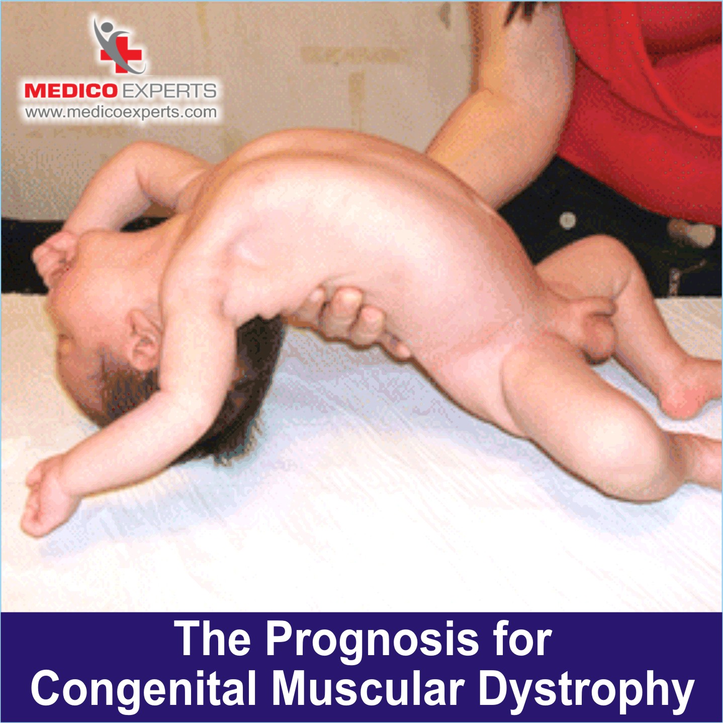 Prognosis for Congenital Muscular Dystrophy