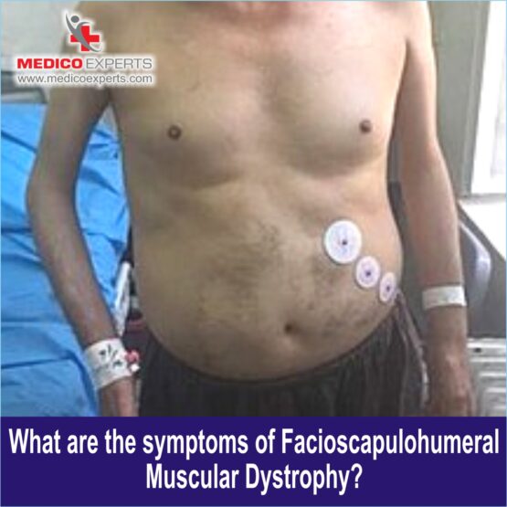 Symptoms of Facioscapulohumeral Muscular Dystrophy