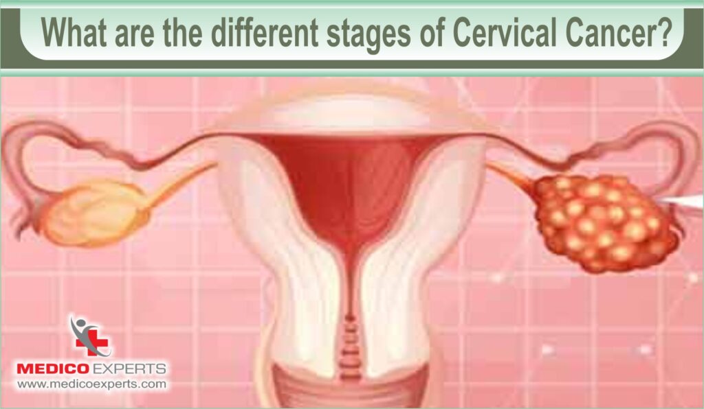 cervical cancer stages and treatment