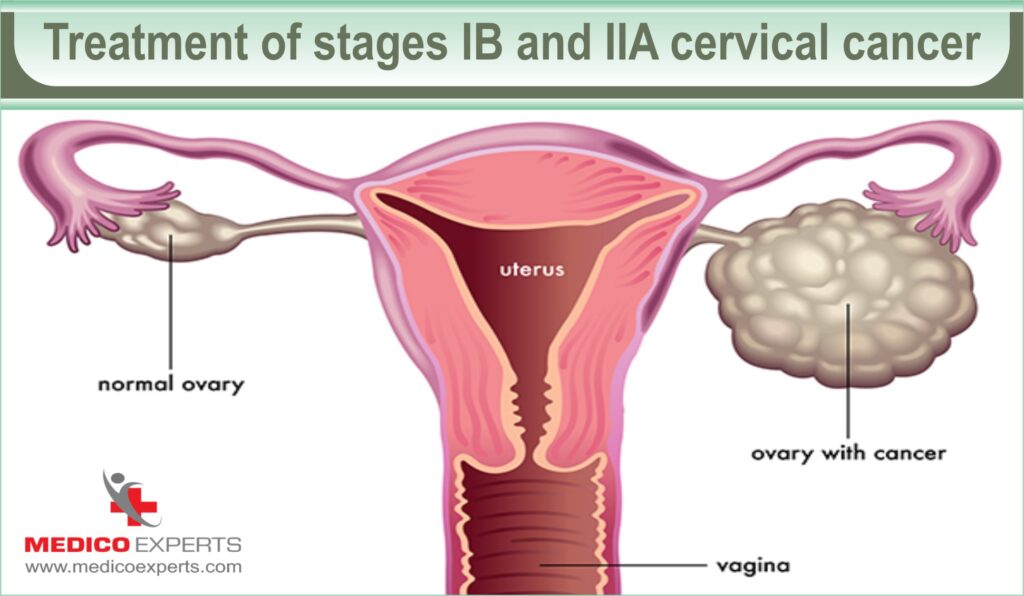 cervical cancer stages and treatment | MedicoExperts