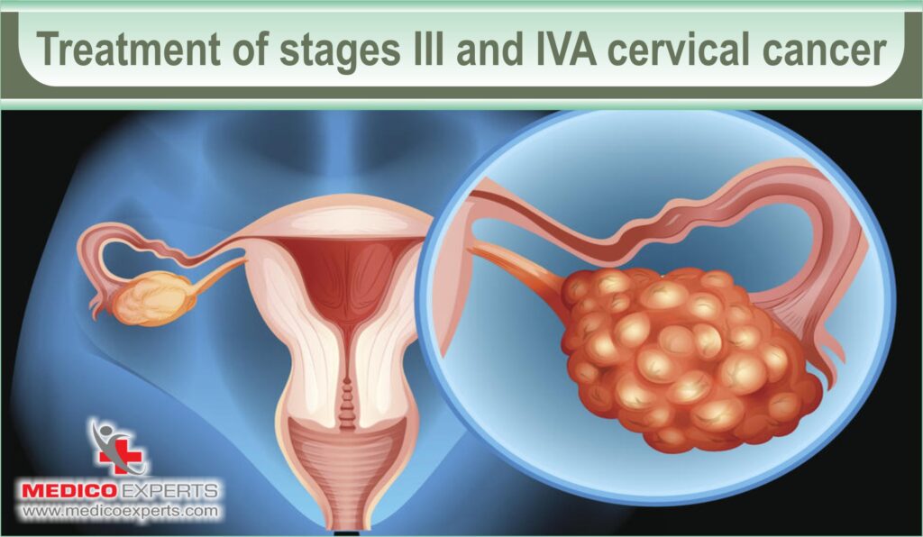 cervical cancer stages and treatment | MedicoExperts