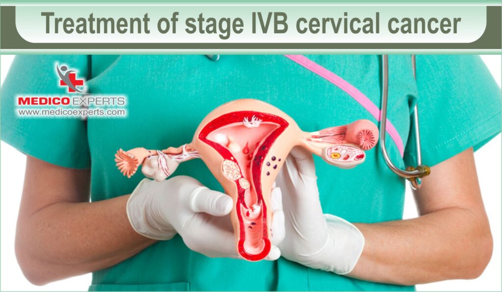 cervical cancer stages and treatment | MedicoExperts