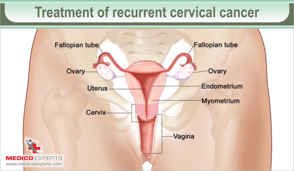 cervical cancer stages and treatment | MedicoExperts