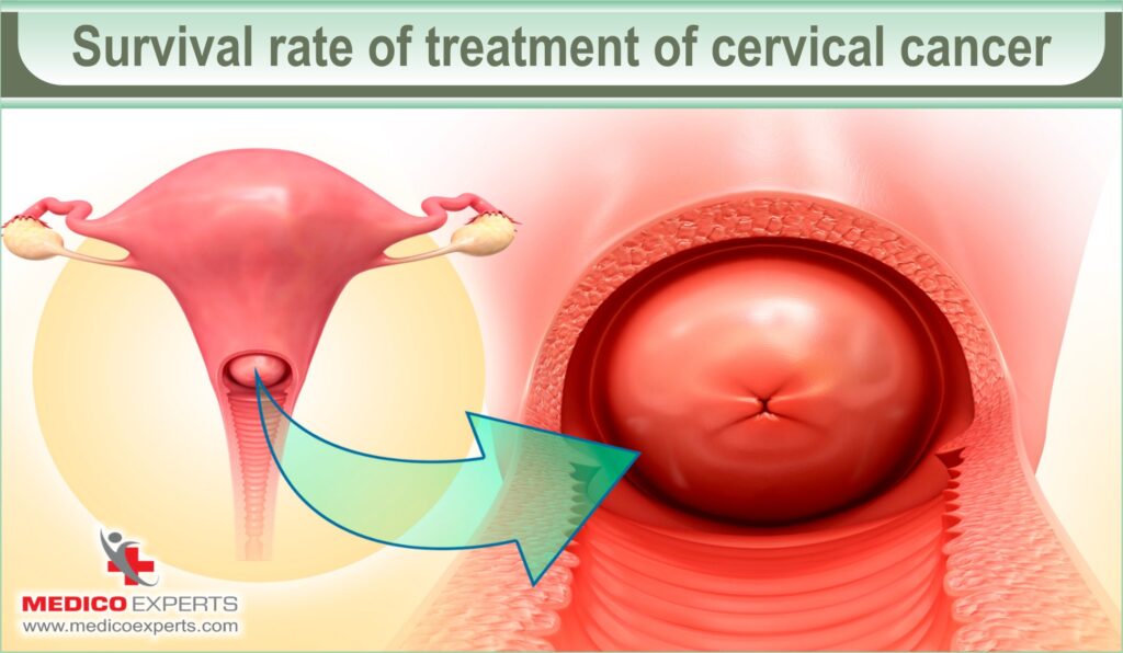 cervical cancer stages and treatment | MedicoExperts