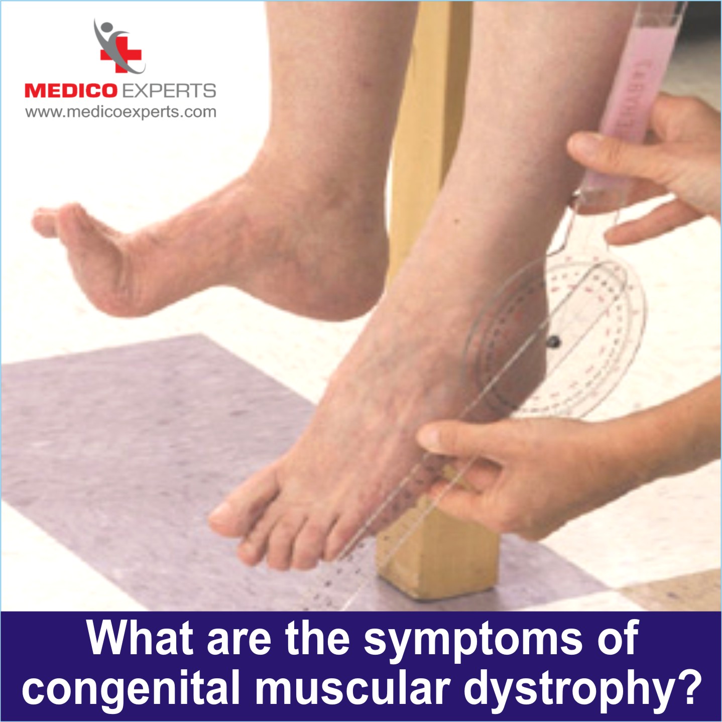 What are the symptoms of Congenital Muscular Dystrophy