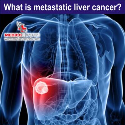 What is Metastatic Liver Cancer