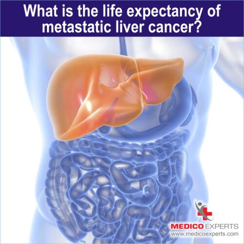 What is the life expectancy of Metastatic Liver Cancer, Metastatic Liver Cancer treatment