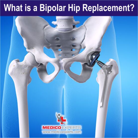 what is Bipolar Hemiarthroplasty