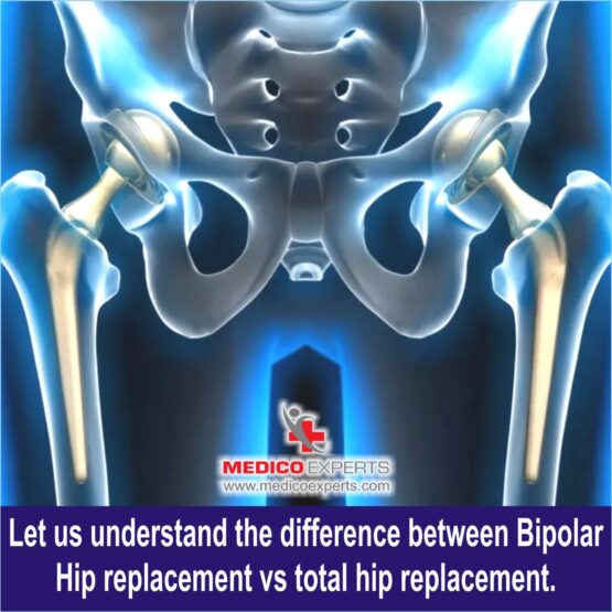 Bipolar Hemiarthroplasty