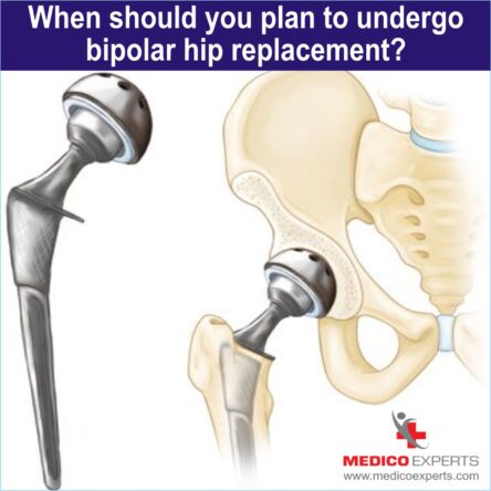 Bipolar Hemiarthroplasty