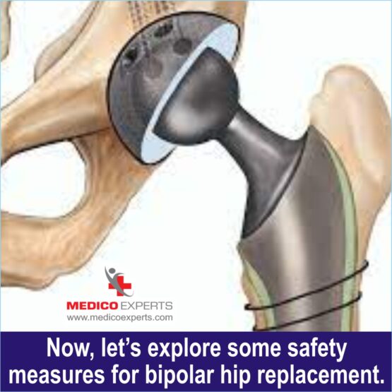 Bipolar Hemiarthroplasty