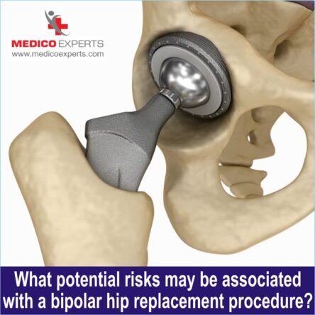 Bipolar Hemiarthroplasty