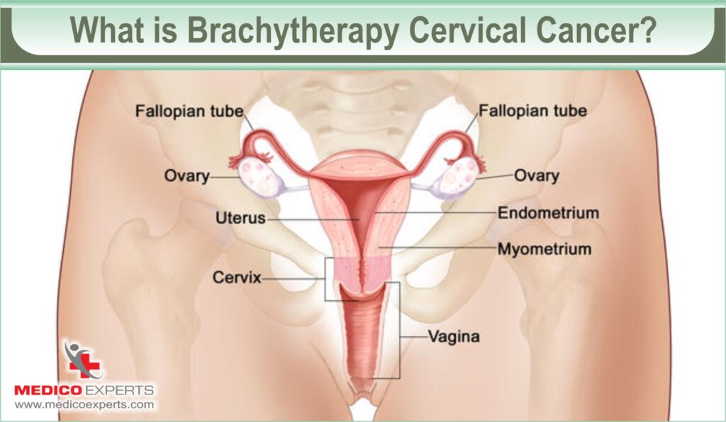 Brachytherapy Cervical Cancer