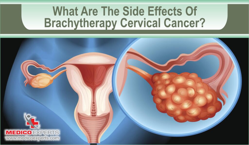 side effects of Brachytherapy for Cervical Cancer