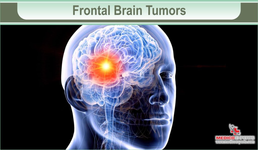 brain tumor symptoms | MedicoExperts