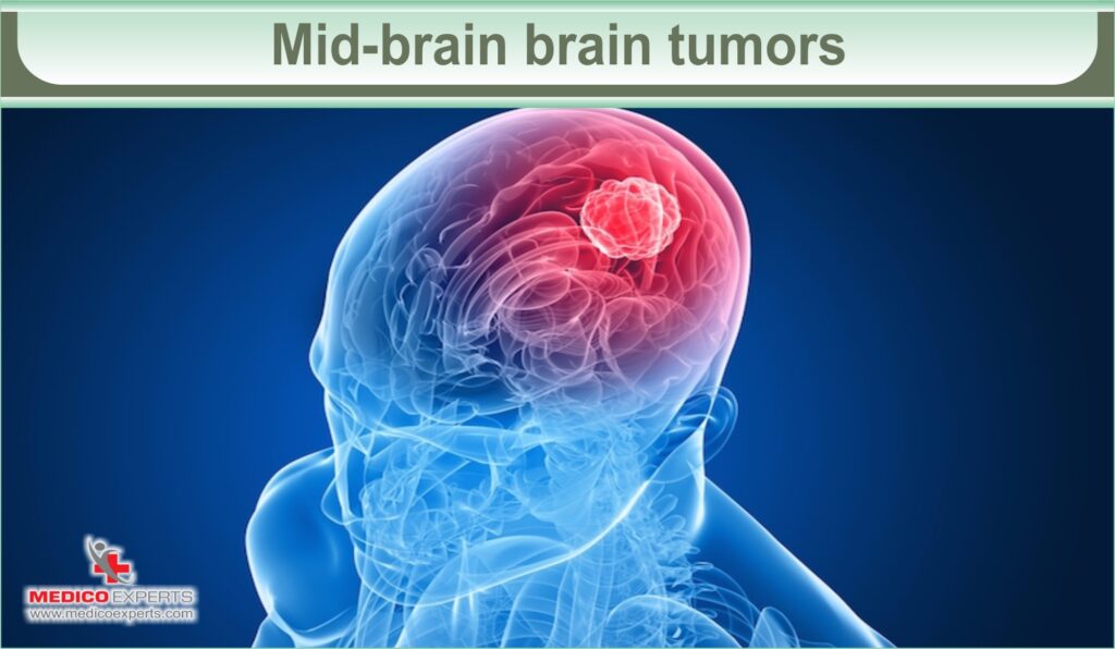 brain tumor symptoms | MedicoExperts