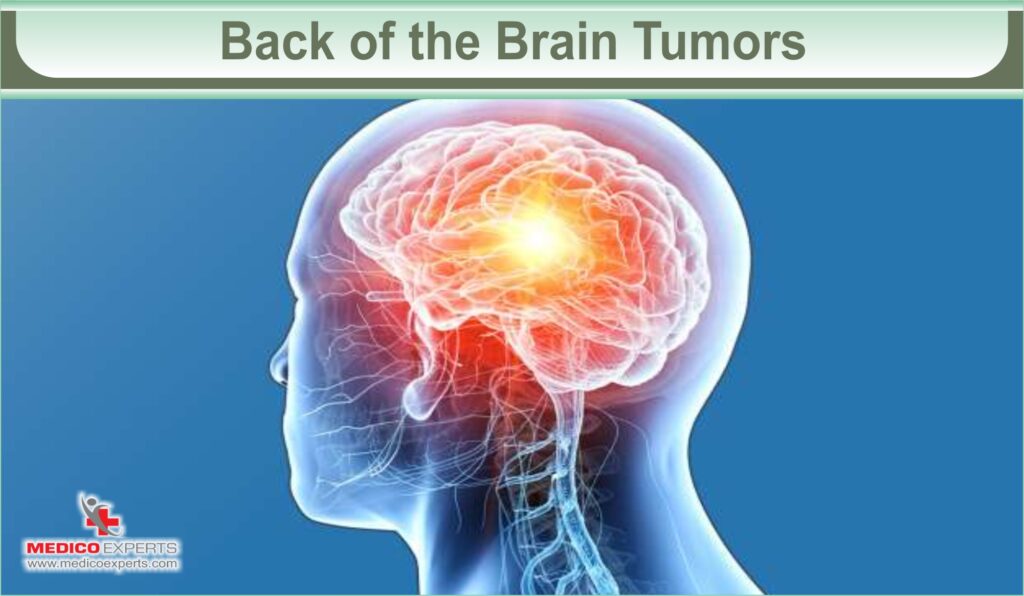 brain tumor symptoms | MedicoExperts