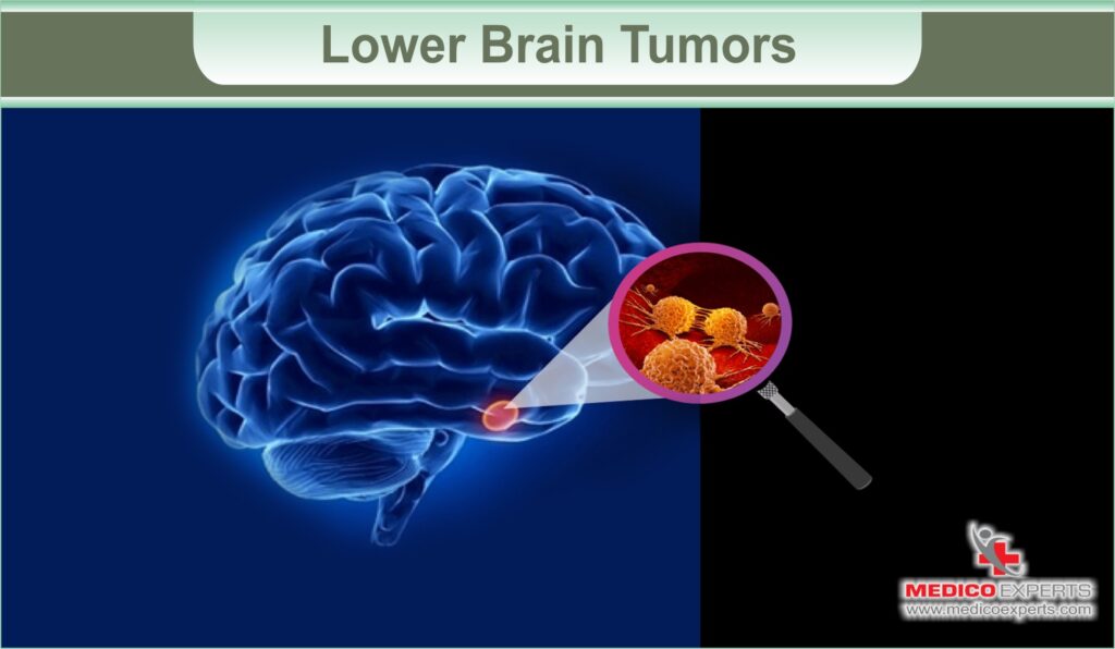 brain tumor symptoms | MedicoExperts