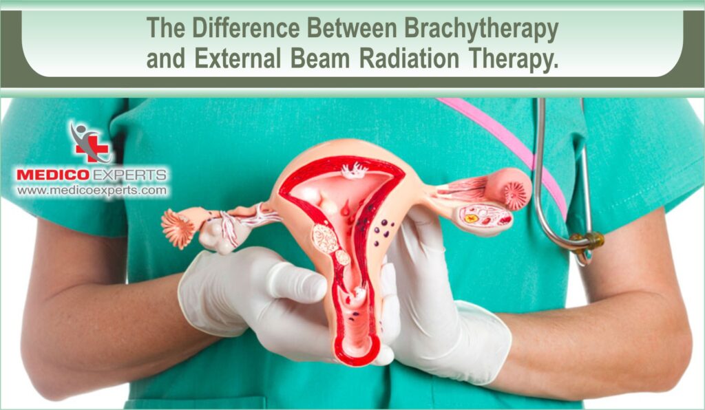 Difference Between Brachytherapy and External Beam Radiation Therapy