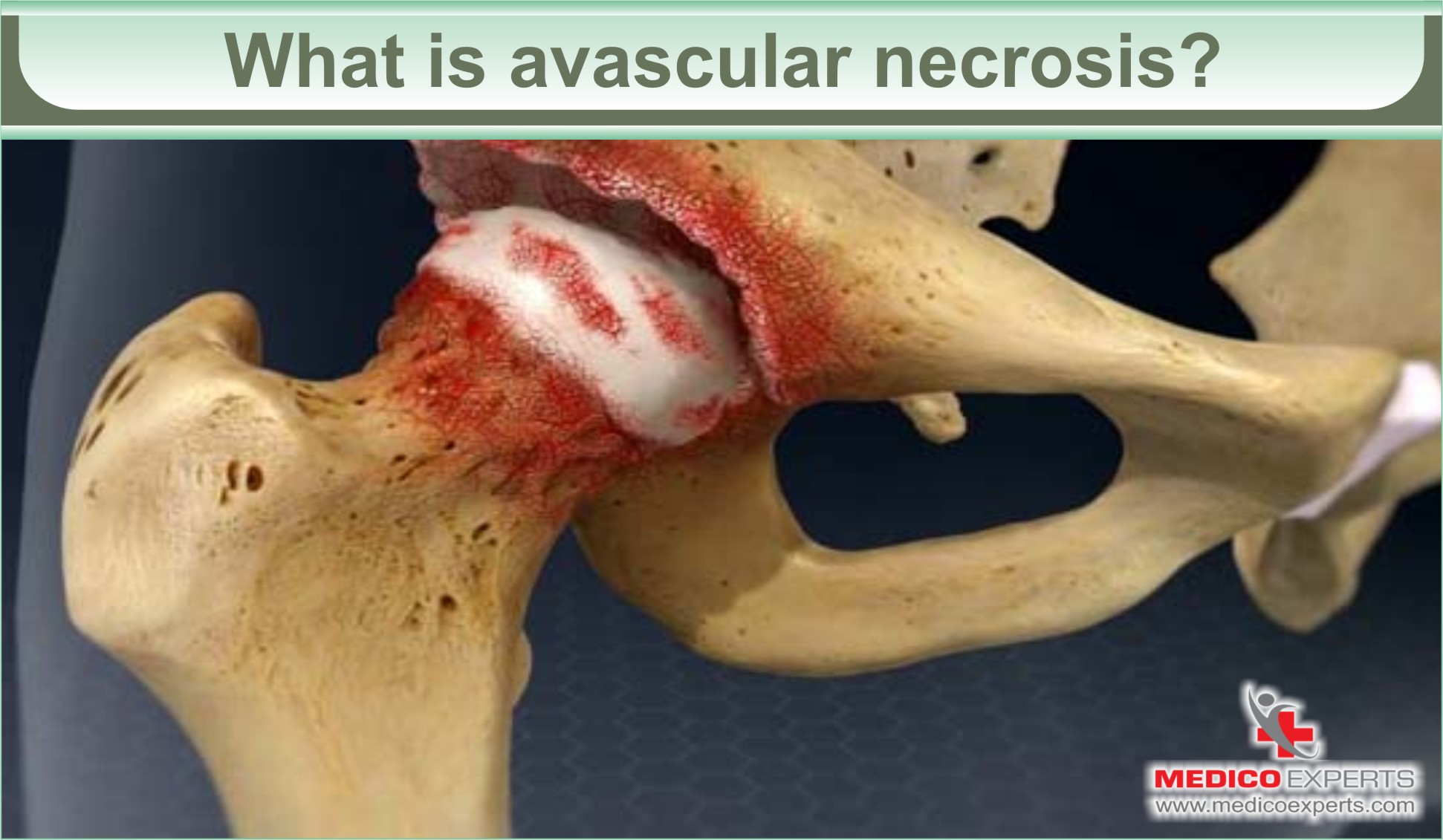 Answered Can Avascular Necrosis be Reversed