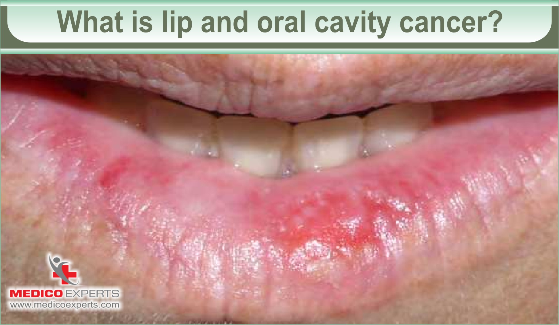 lip-and-oral-cavity-cancer-causes-and-treatment