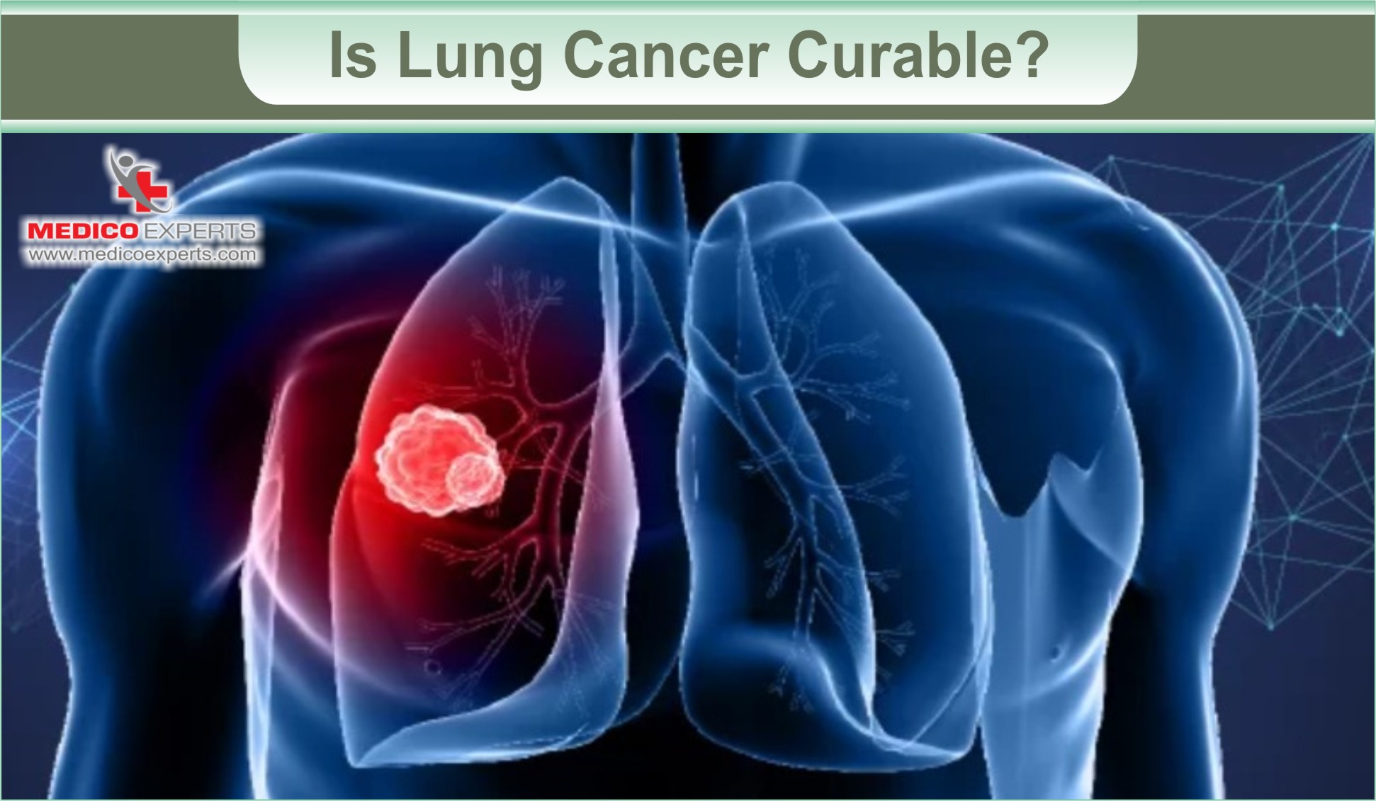 Is lung cancer curable with advanced therapies?