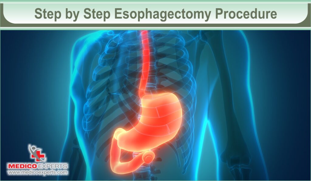 Esophagectomy Surgery: Procedure, Risk, & Benefits