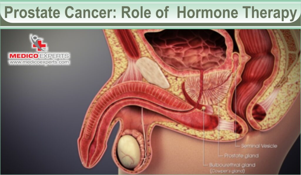 hormone therapy for cancer | MedicoExperts