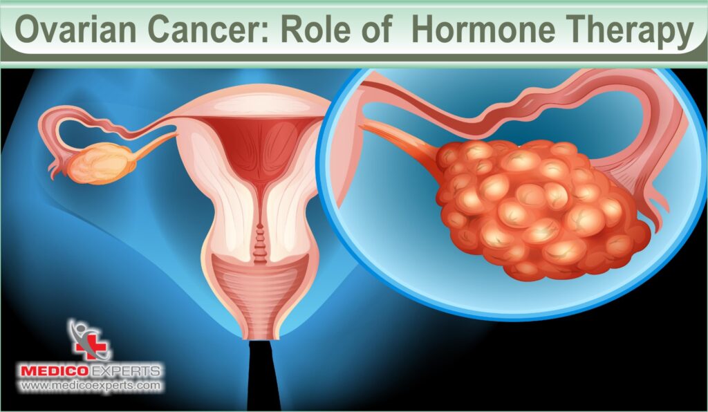 hormone therapy for cancer | MedicoExperts