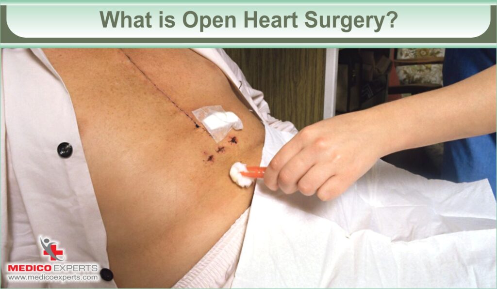 open heart surgery in india