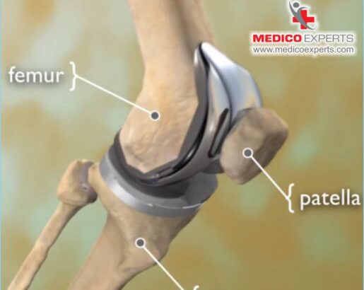 what is robotic knee replacement