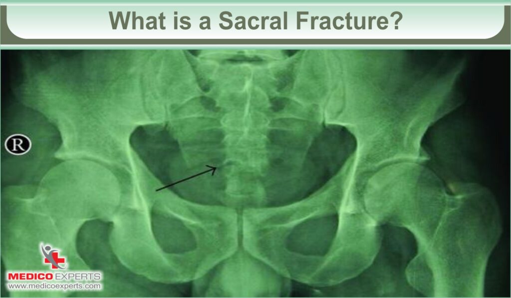 sacral fracture treatment