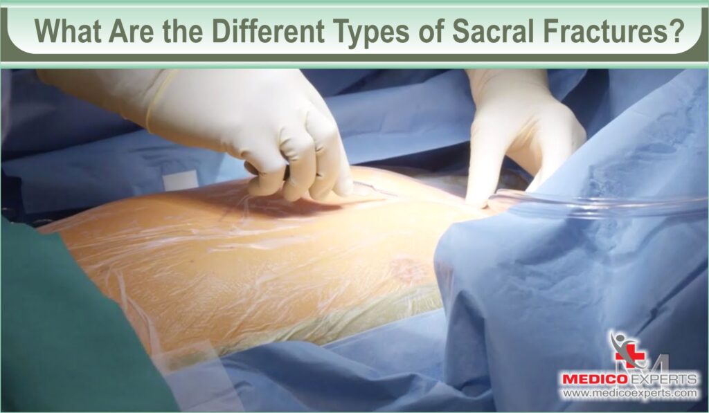 sacral fracture treatment | MedicoExperts