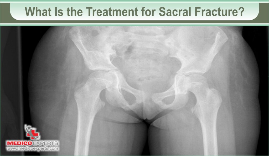 sacral fracture treatment | MedicoExperts