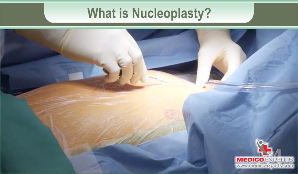 nucleoplasty