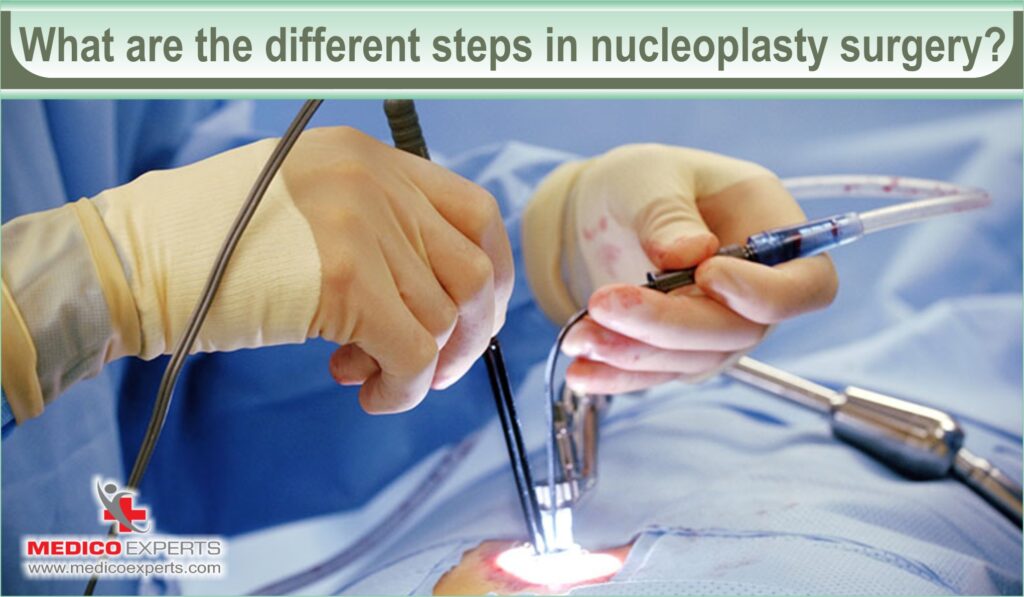 nucleoplasty surgery