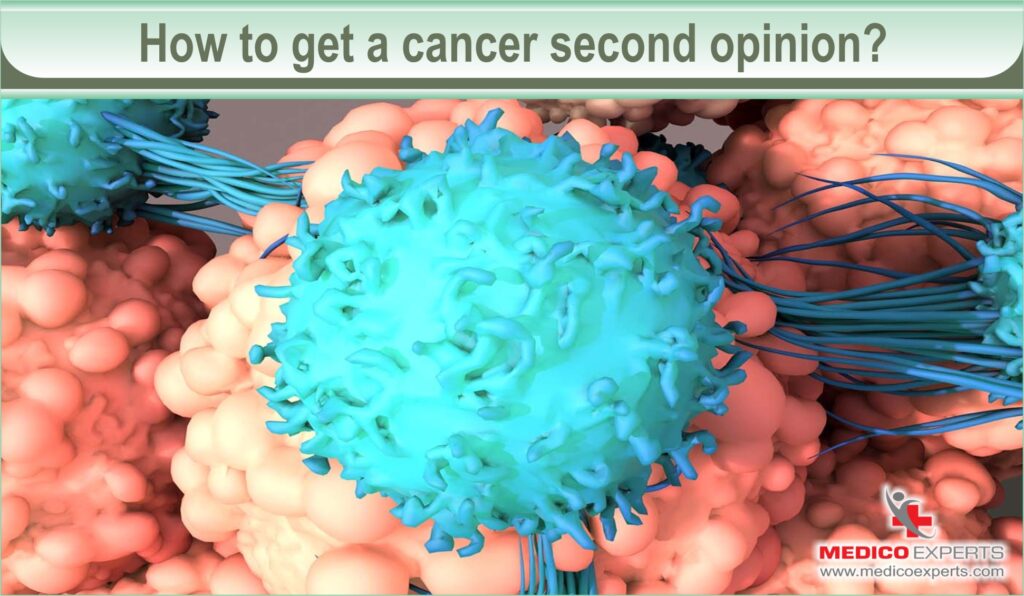 cancer second opinion | MedicoExperts