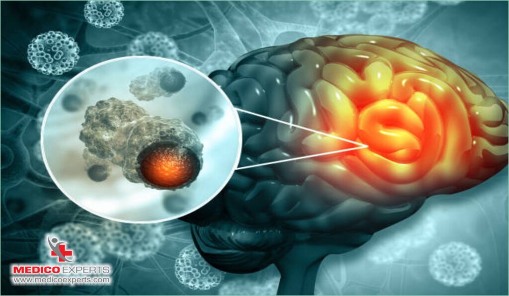 What is Motor Neuron Disease (MND)?, motor neuron disease treatment in India, Is motor neuron disease curable in India?