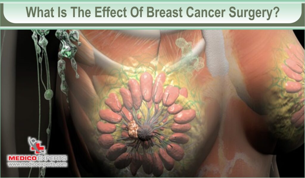 how urgent is breast cancer surgery | MedicoExperts