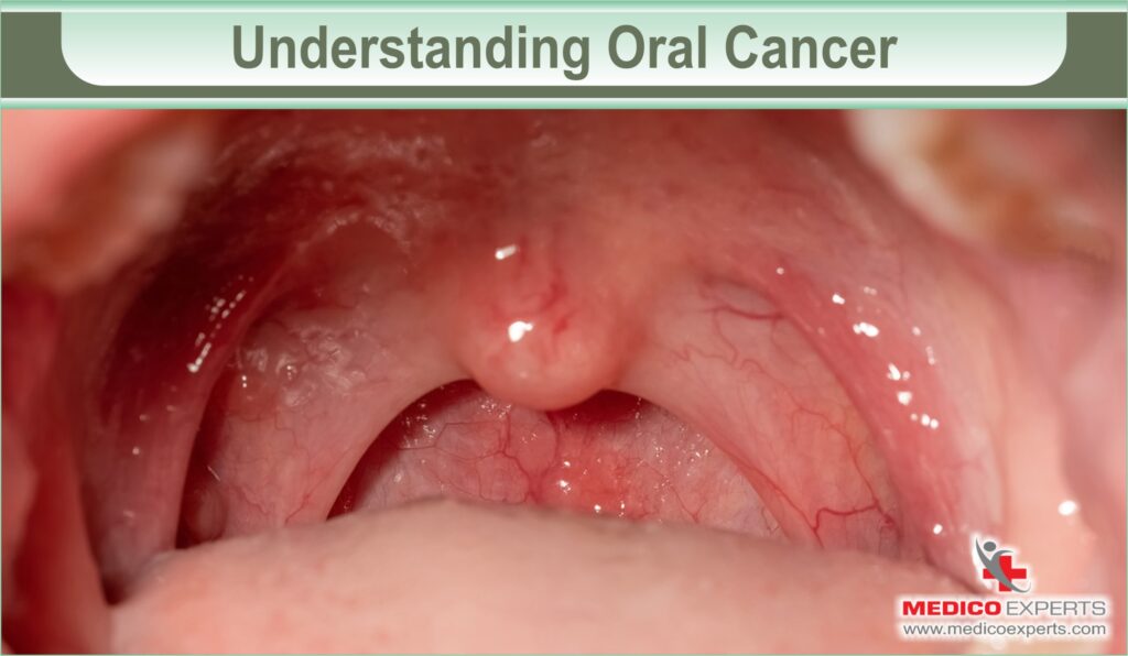 understanding oral cancer