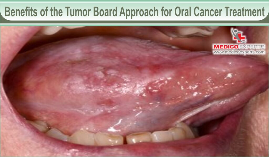 oral cancer treatment