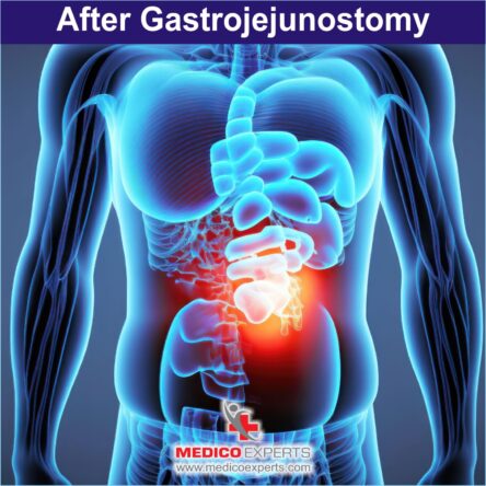 After Gastrojejunostomy