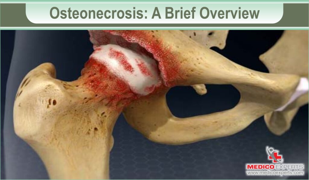 Osteonecrosis Treatments