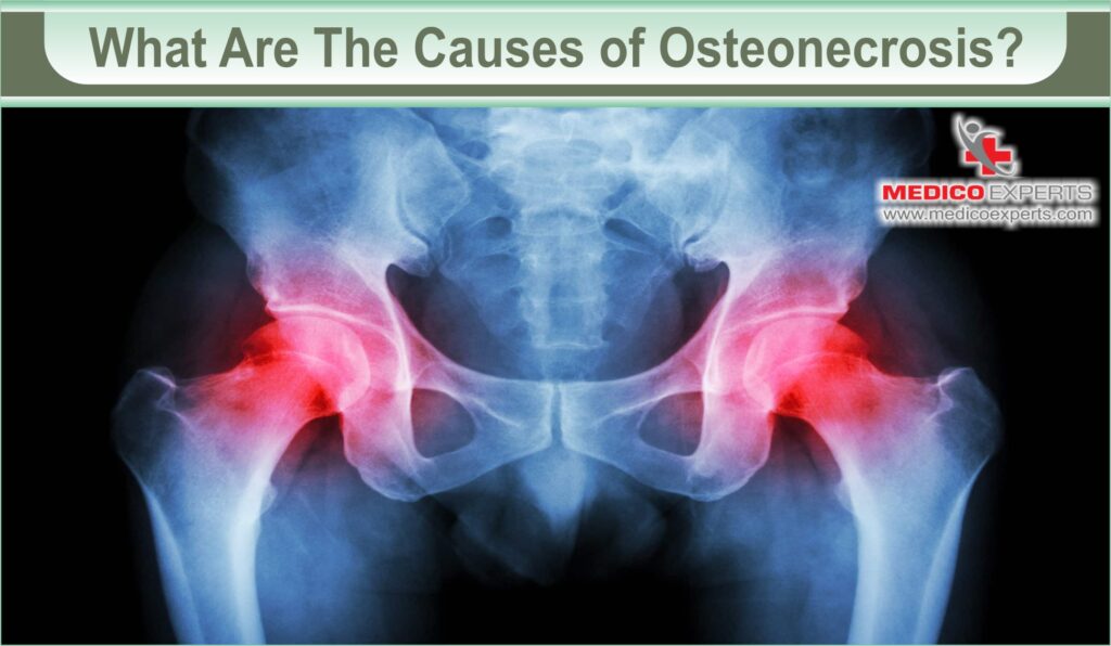 Osteonecrosis Treatments | MedicoExperts